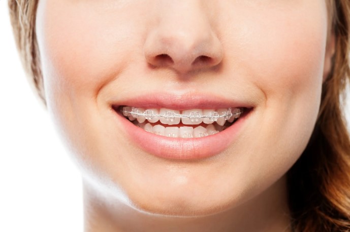 металеві або керамічні брекети металеві або керамічні брекети